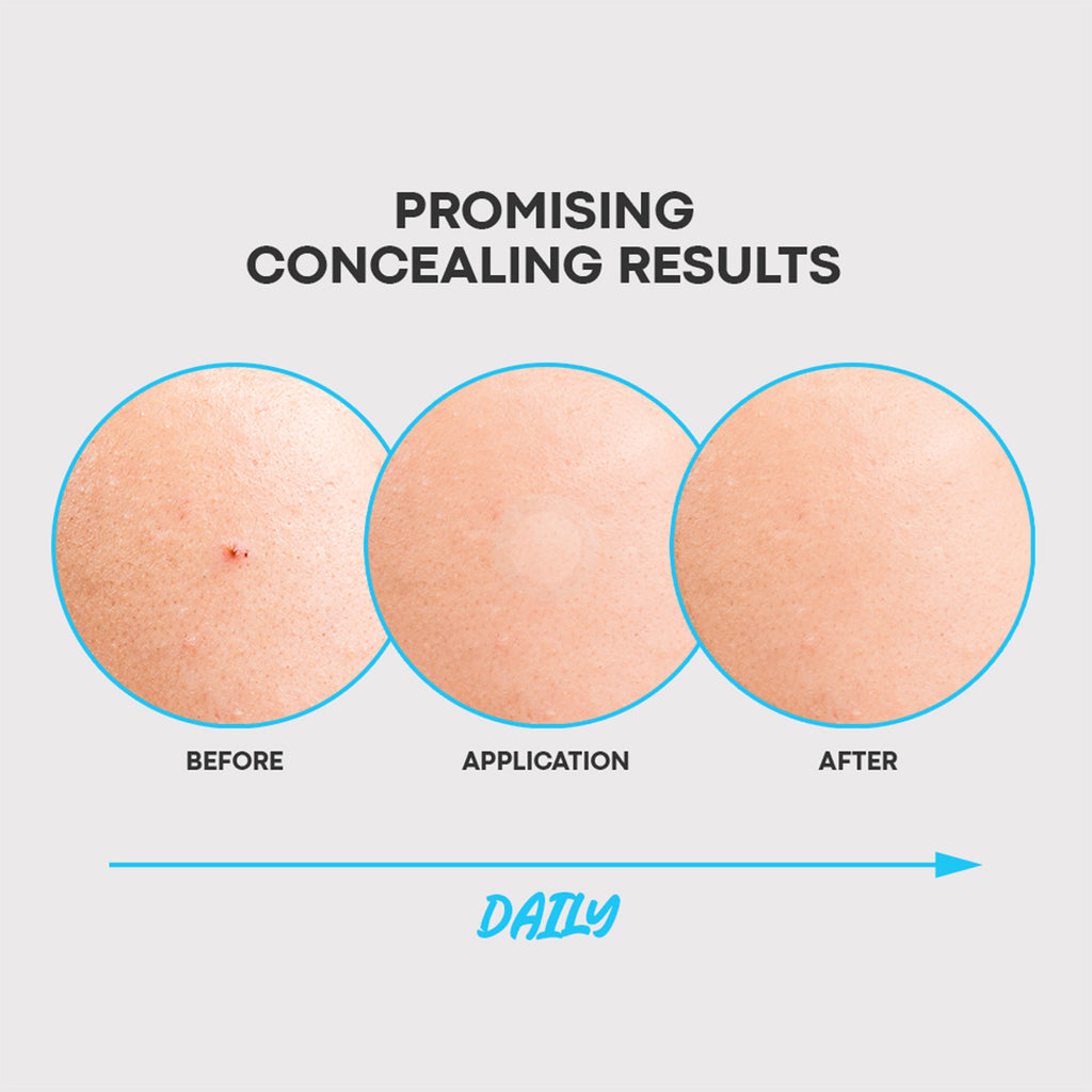 Step 2: NOLAHOUR Hydrocolloid Invisible Patch