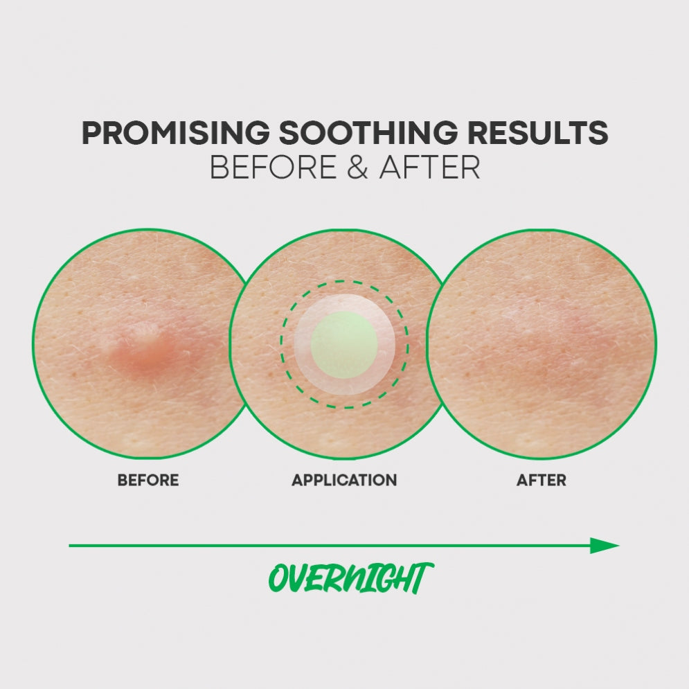 Step 1: NOLAHOUR Green Micropoint Pimple Patch